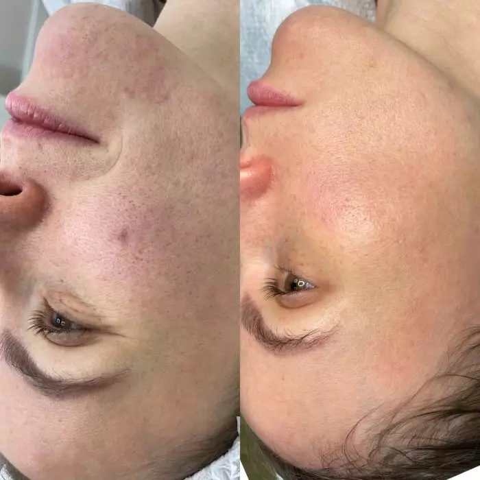 Фракционный фототермолиз (Лазерная шлифовка) Halo