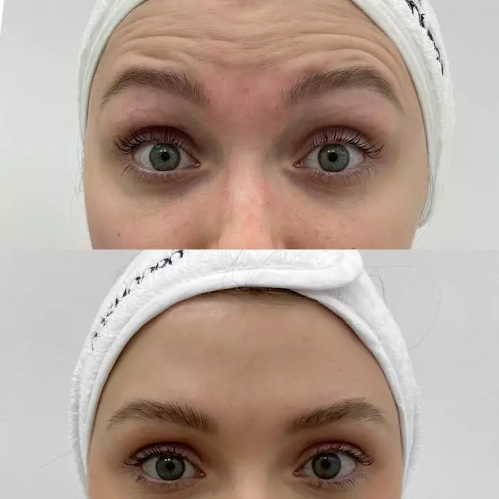 Ботулинотерапия