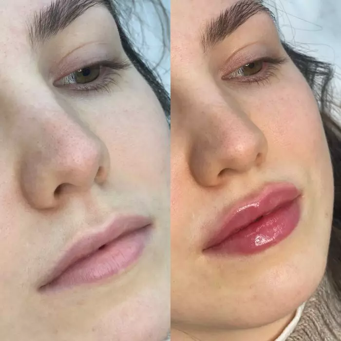 Контурная пластика губ