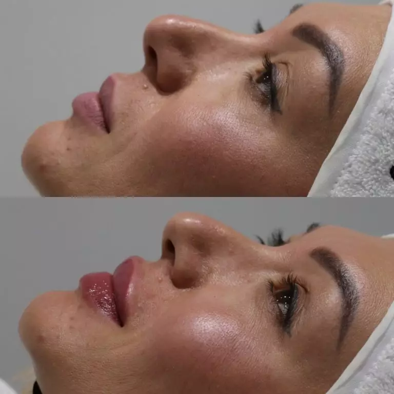 Контурная пластика губ