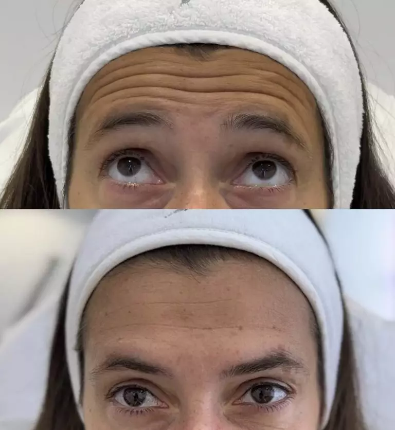 Ботулинотерапия