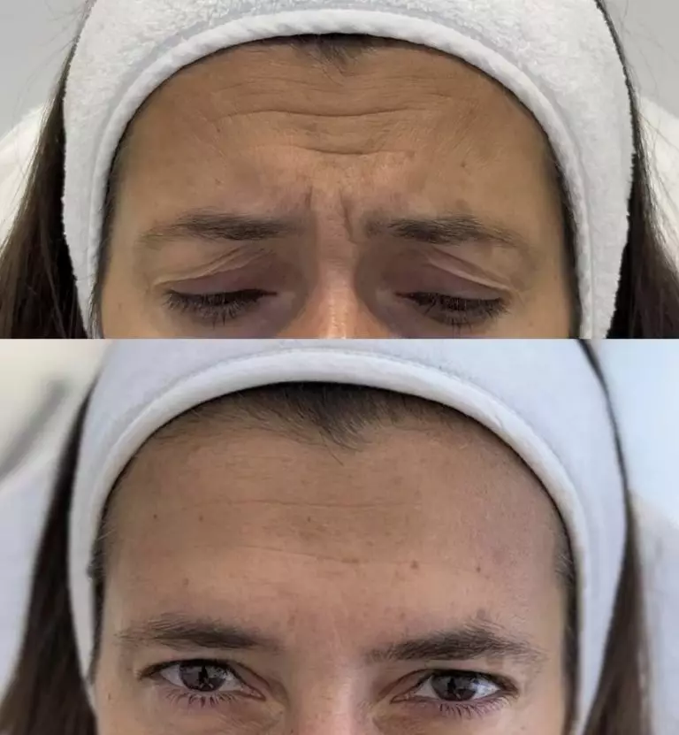 Ботулинотерапия