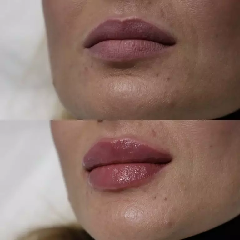 Контурная пластика губ