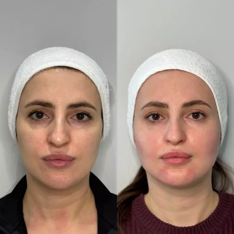 Гармонизация лица препаратом Radiess