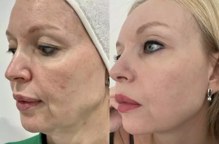 Комплексный Anti-age протокол