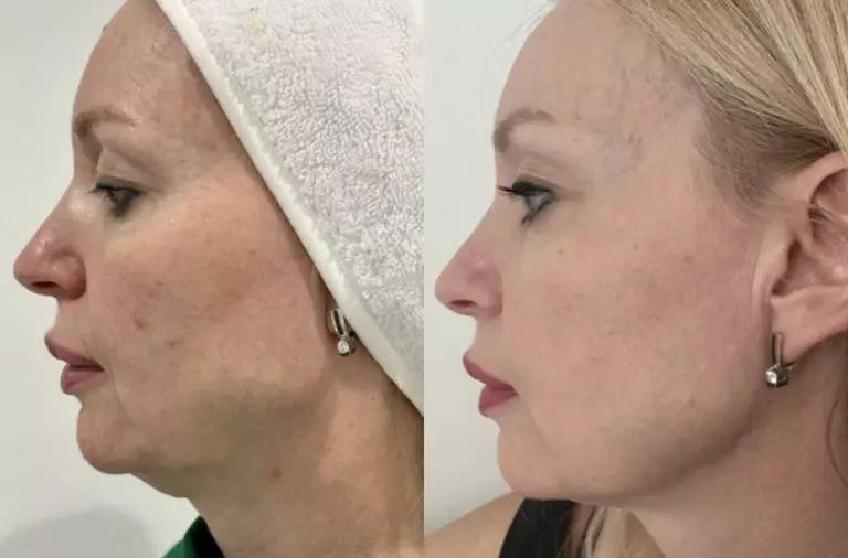 Комплексный Anti-age протокол