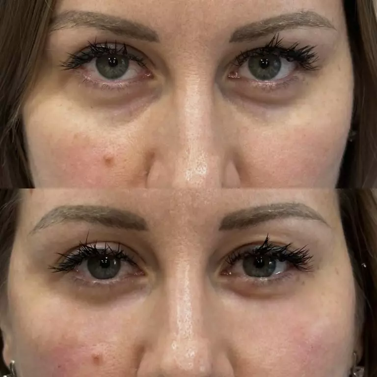 Коррекция носослезной борозды