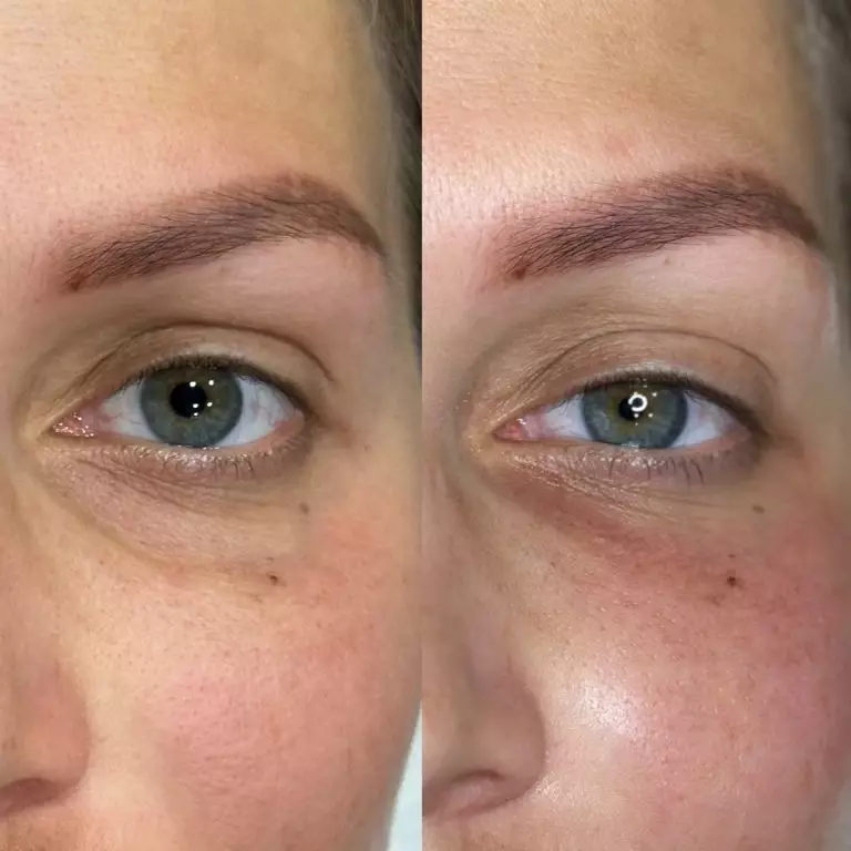 Коррекция носослезной борозды