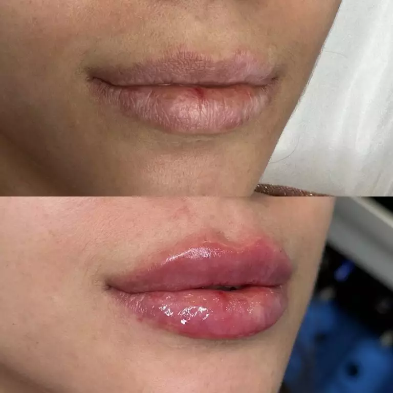 Контурная пластика губ