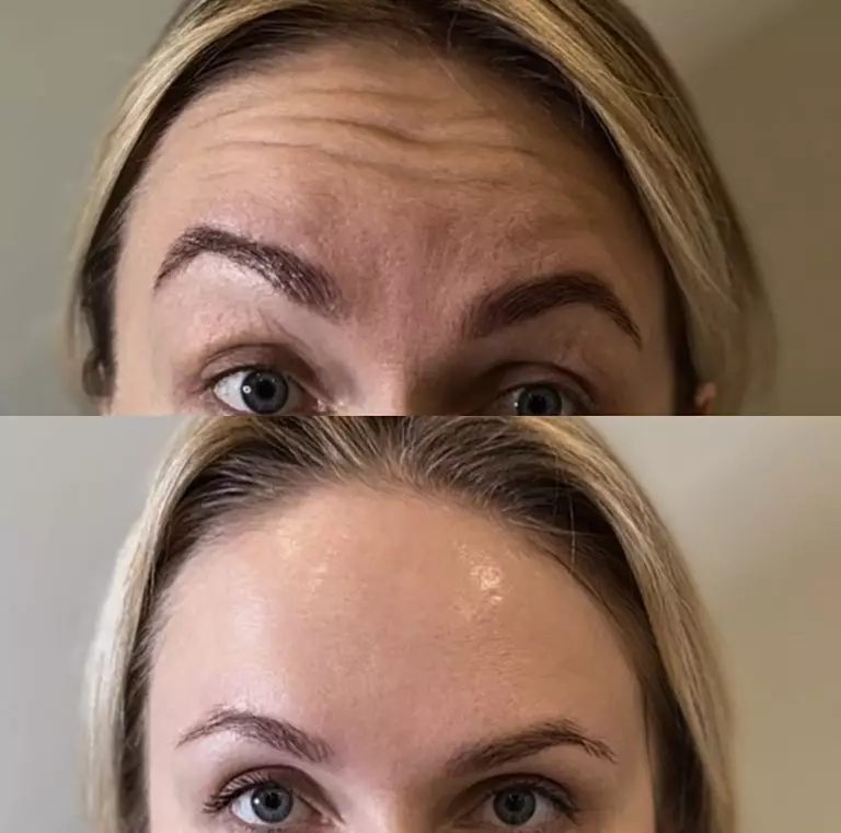 Ботулинотерапия