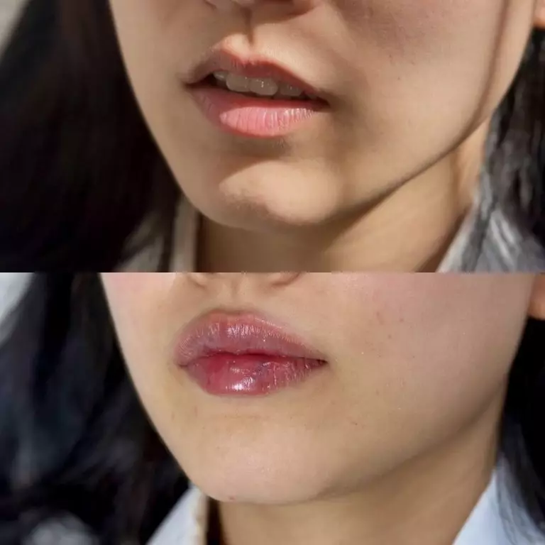 Контурная пластика губ