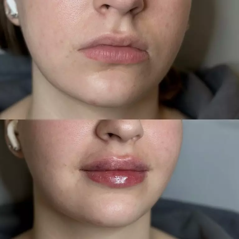 Контурная пластика губ