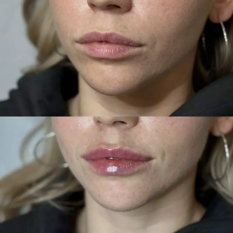 Контурная пластика губ