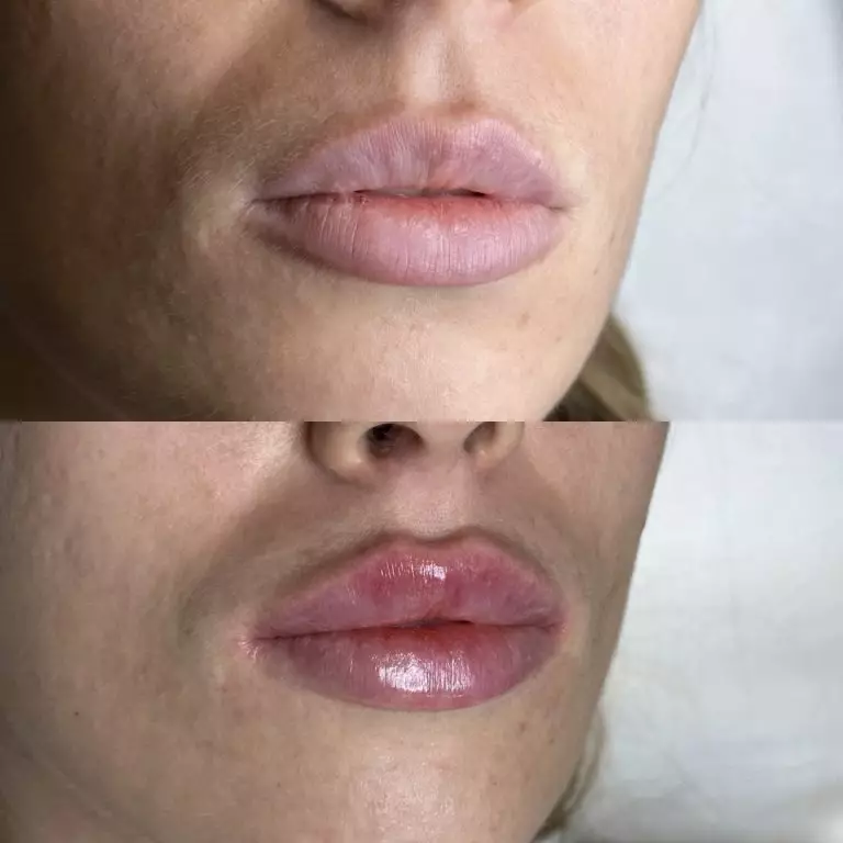 Контурная пластика губ