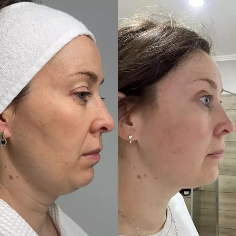 Игольчатый РФ-лифтинг Genius