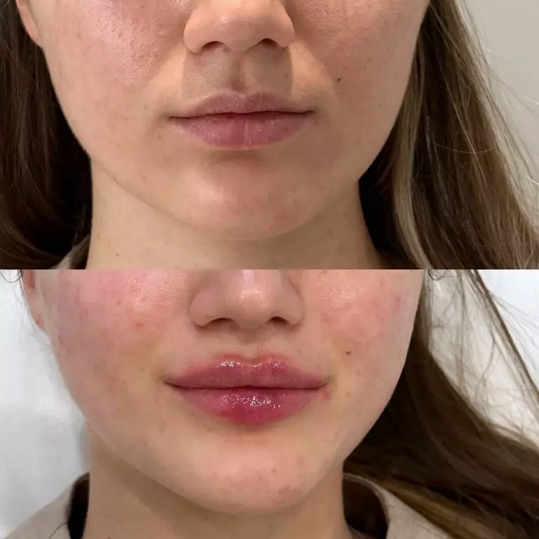 Контурная пластика губ