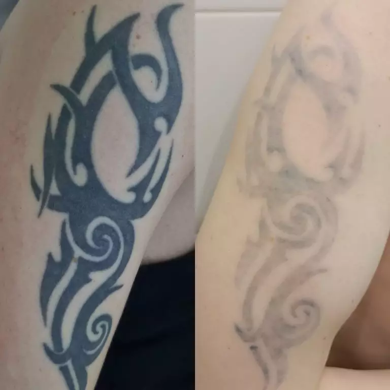 Удаление тату лазером - 4 процедуры