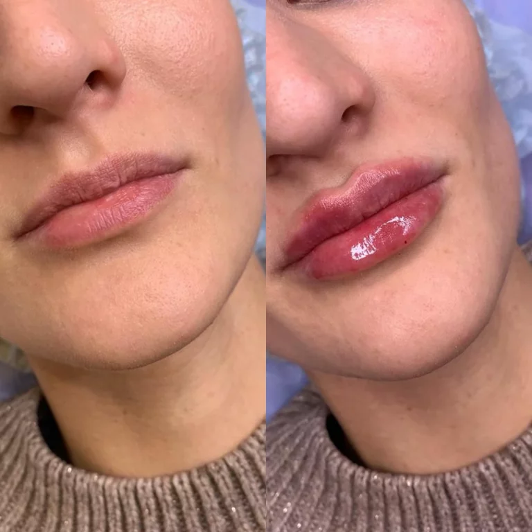 Контурная пластика губ