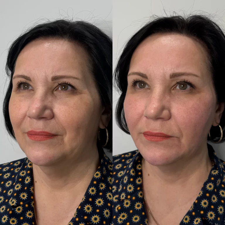 Гармонизация лица (Radiesse)