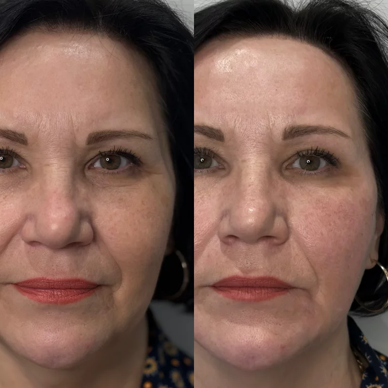 Гармонизация лица (Radiesse)