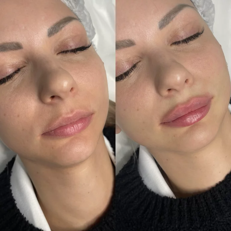 Контурная пластика губ