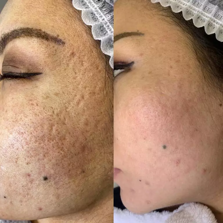 Фракционный фототермолиз/Лазерная шлифовка