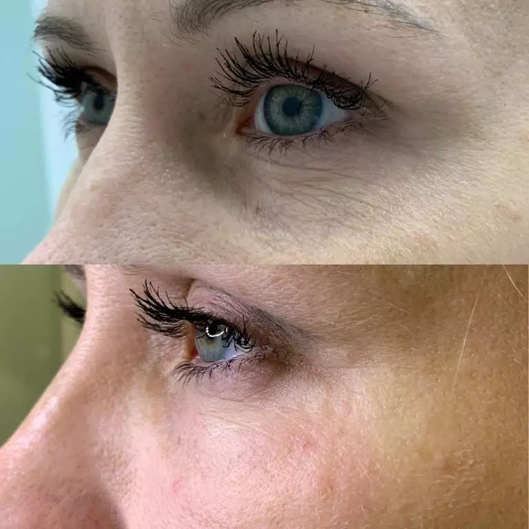 Коррекция носослезной борозды