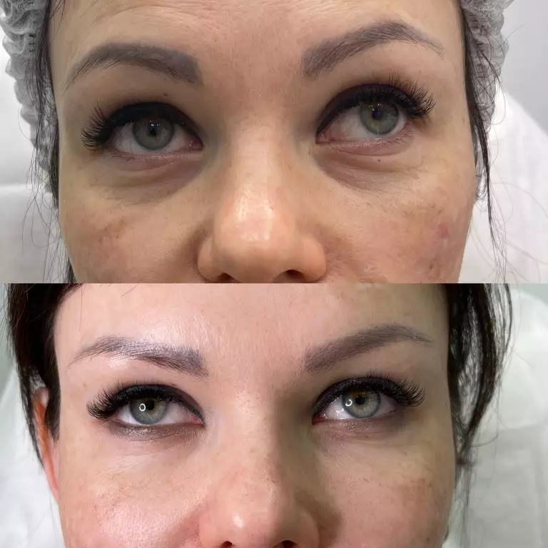 Коррекция носослезной борозды