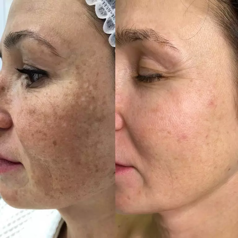 Лечение пигментации