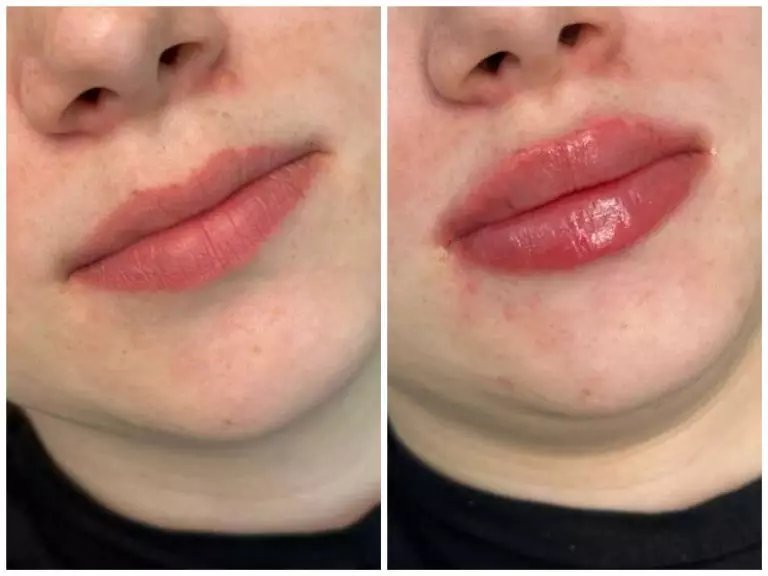 Контурная пластика губ, врач Луковкина А.А.