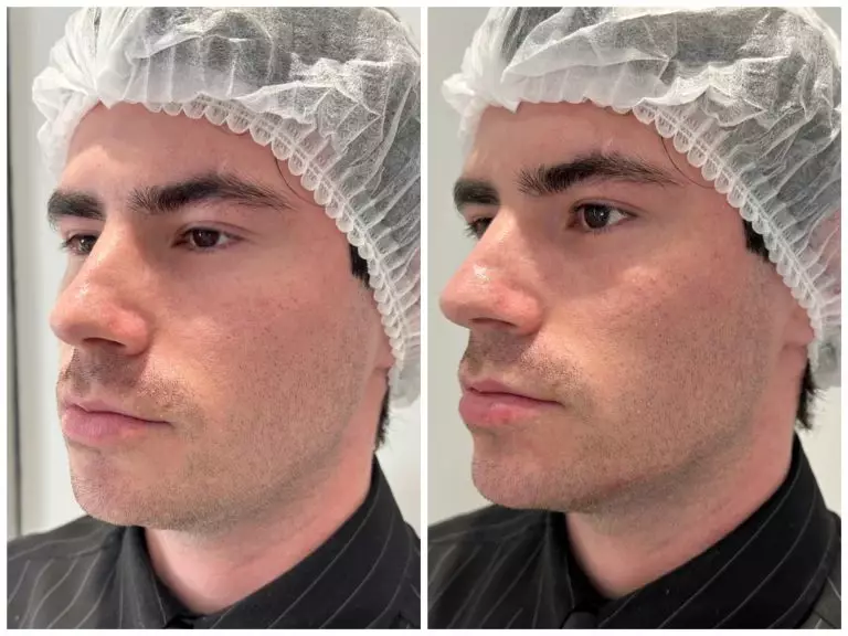 Коррекция нижней трети лица, врач Колмаков К.С.