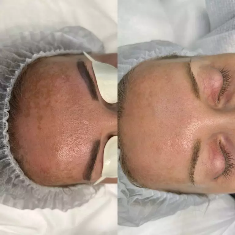 Лечение пигментации