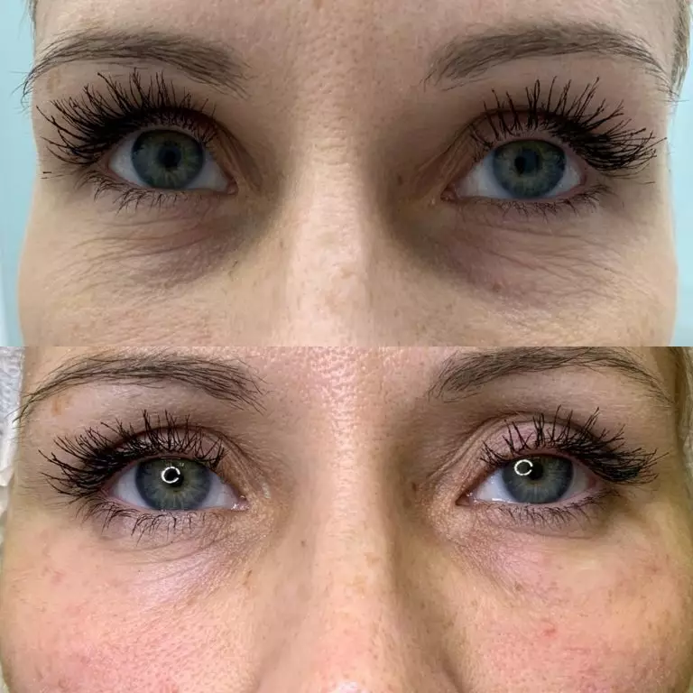 Коррекция носослезной борозды