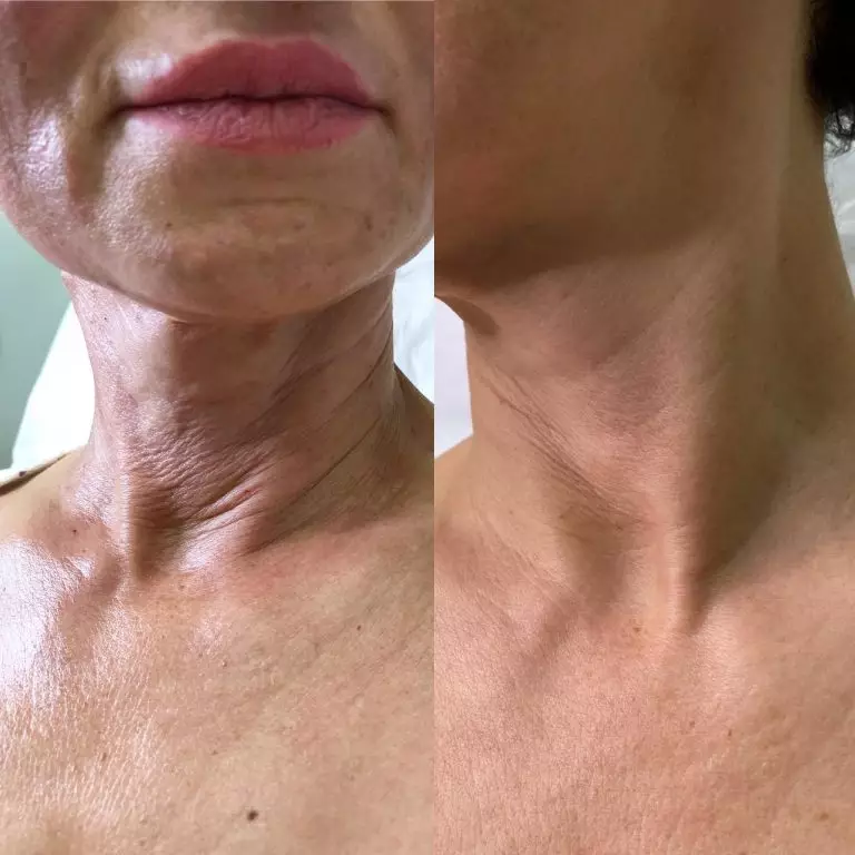 Инъекции полимолочной кислотой - 2 процедуры