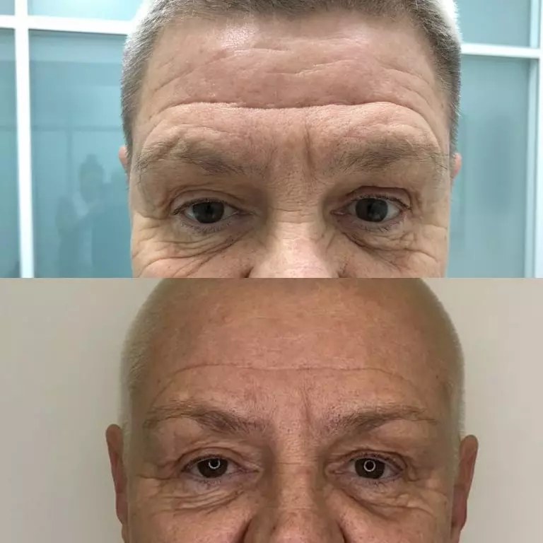 Ботулинотерапия