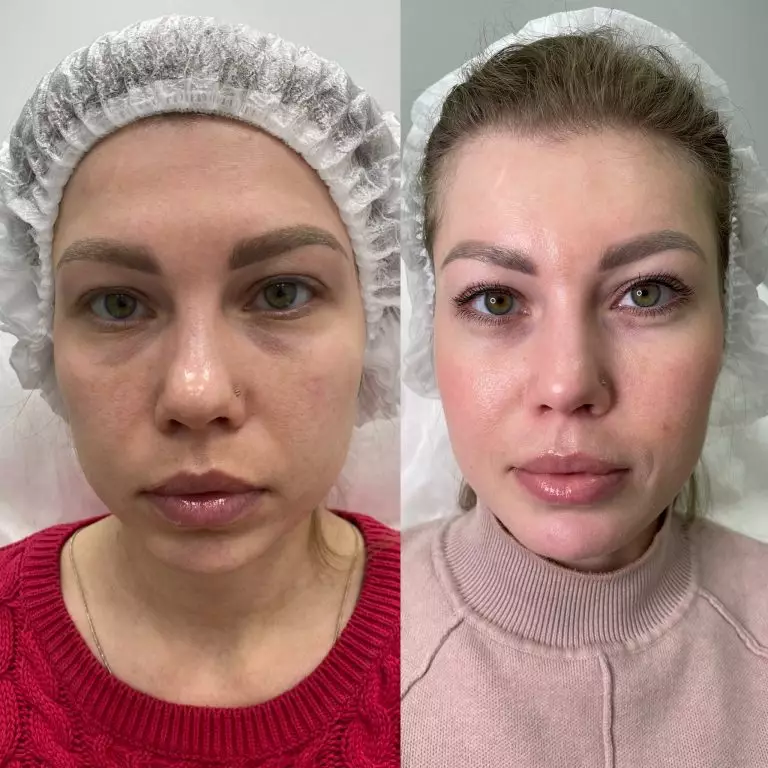 Коррекция носослезной борозды