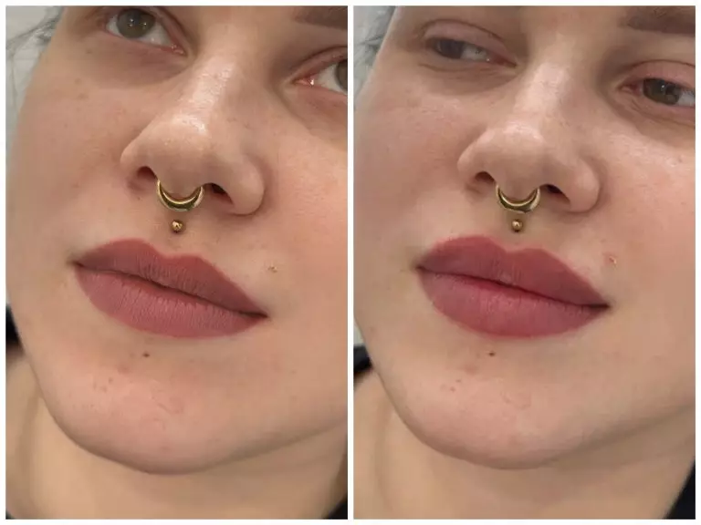 Контурная пластика губ, врач Колмаков К.С.