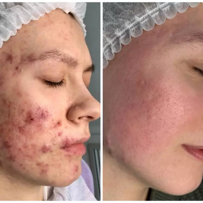 Комплексное лечение акне + Лазерная шлифовка