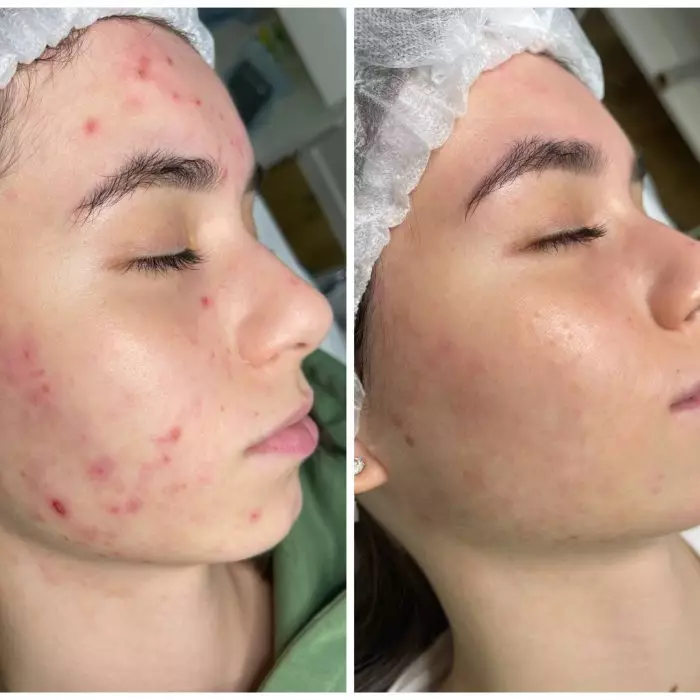 Лечение эскориированного акне