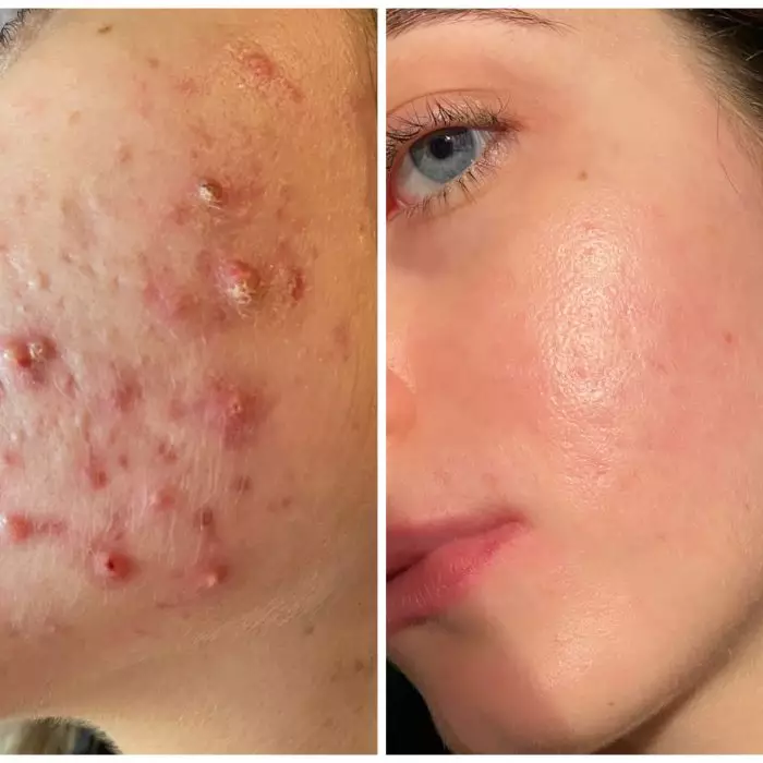 Комплексное лечение акне - дистанционно