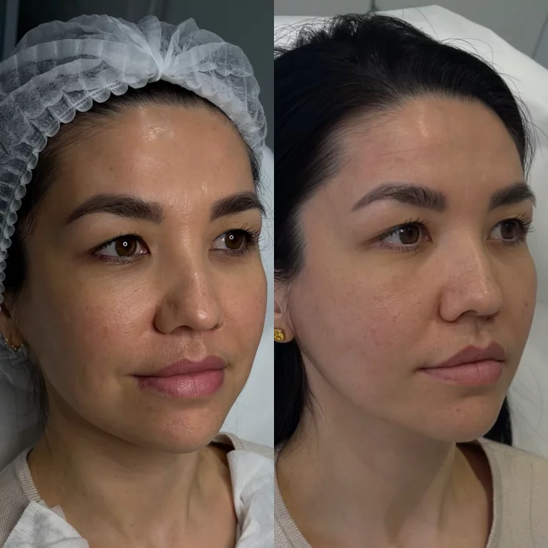 SMAS-лифтинг Ultraformer MPT