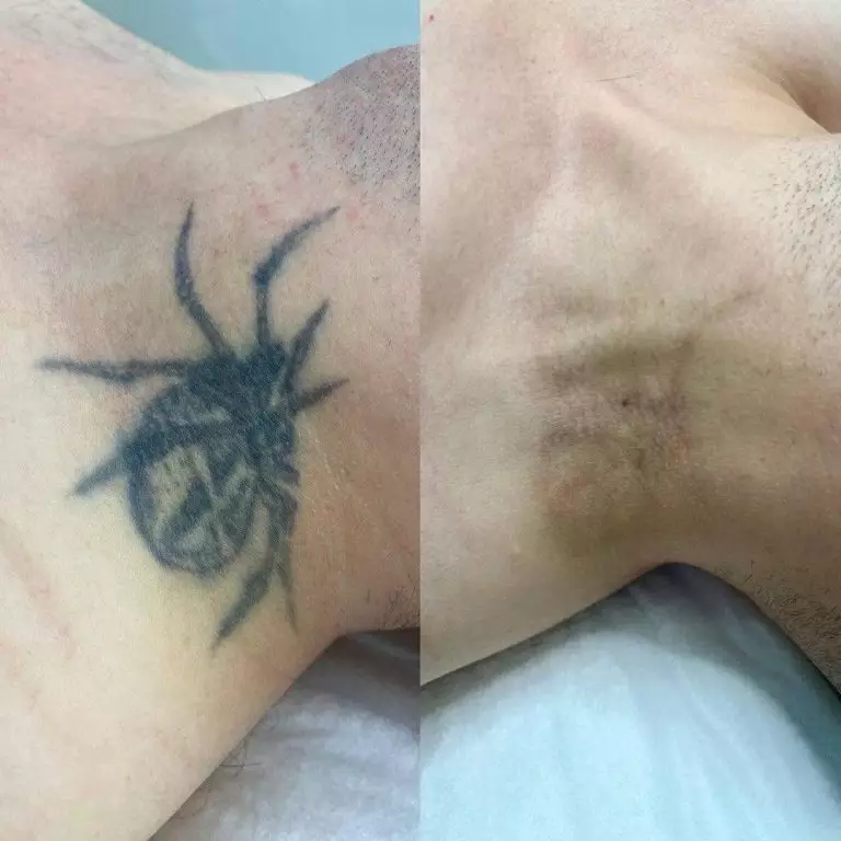 Удаление тату лазером - 5 процедур