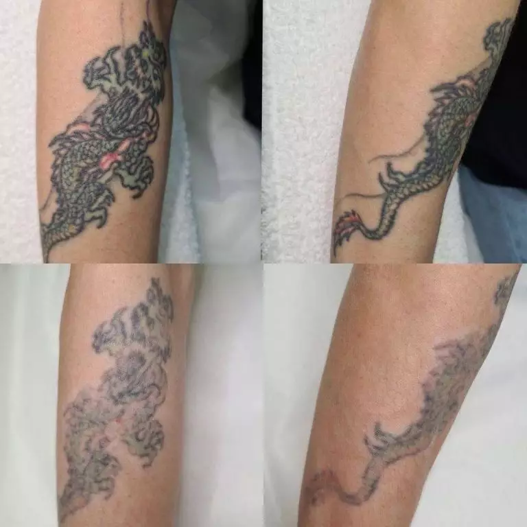 Удаление тату лазером - 3 процедуры