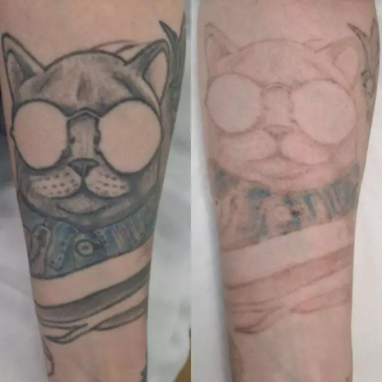 Удаление тату лазером - 3 процедуры