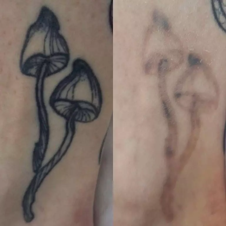 Удаление тату лазером - 5 процедур