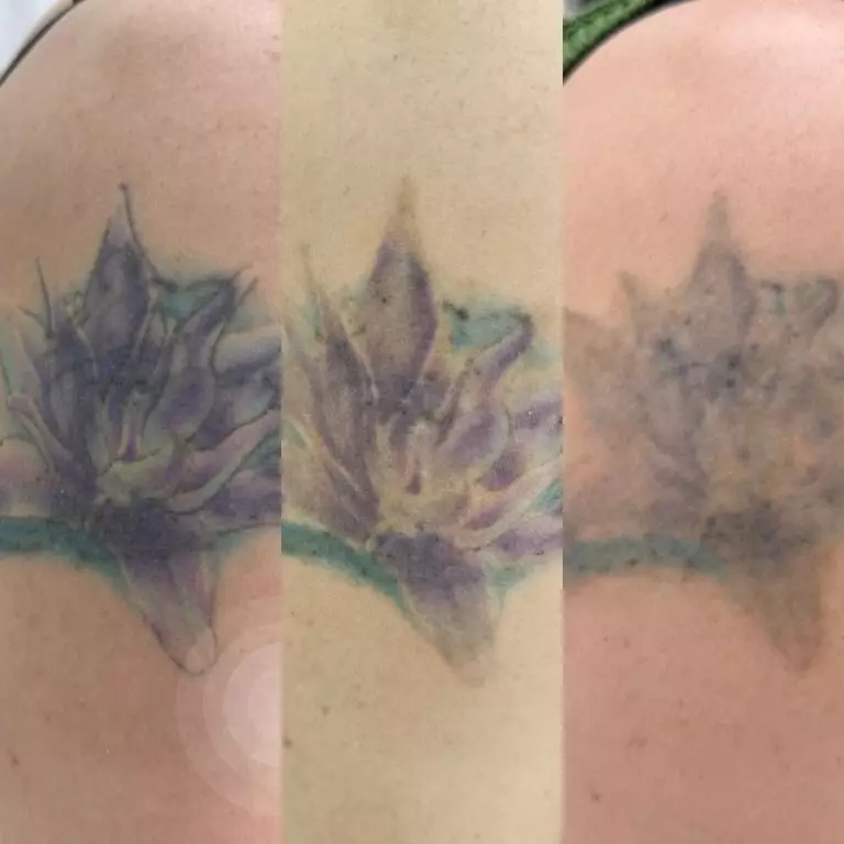 Удаление тату лазером - 2 процедуры