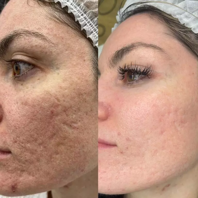 Фракционный фототермолиз/Лазерная шлифовка