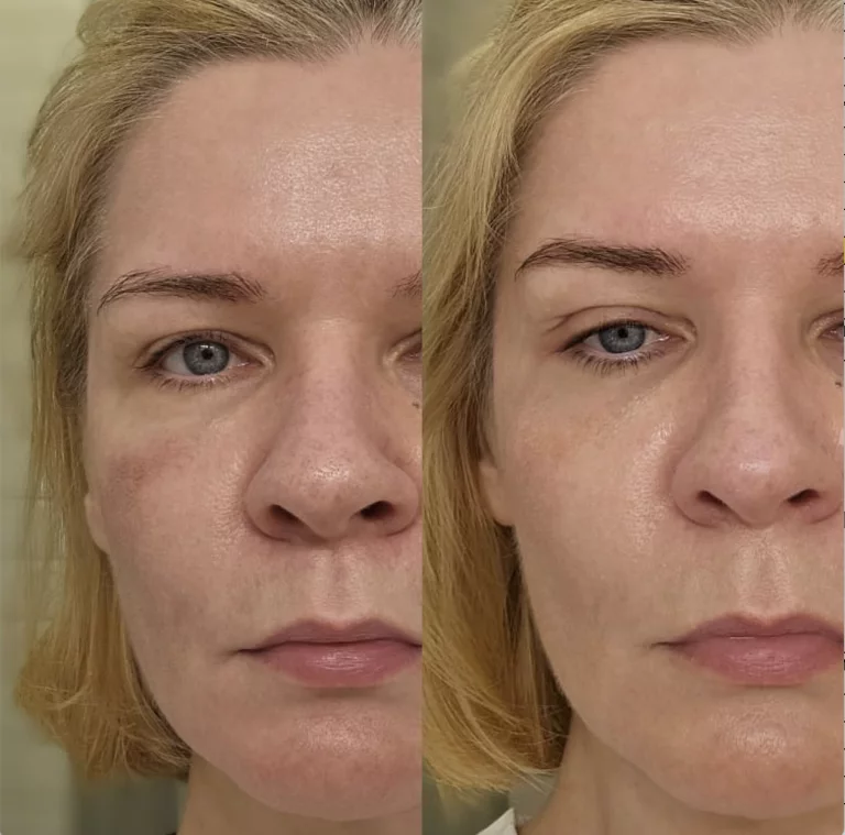 MOXI лечение пигментации