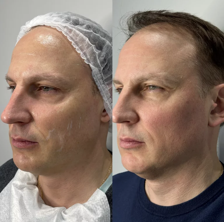 SMAS-лифтинг Ultraformer MPT