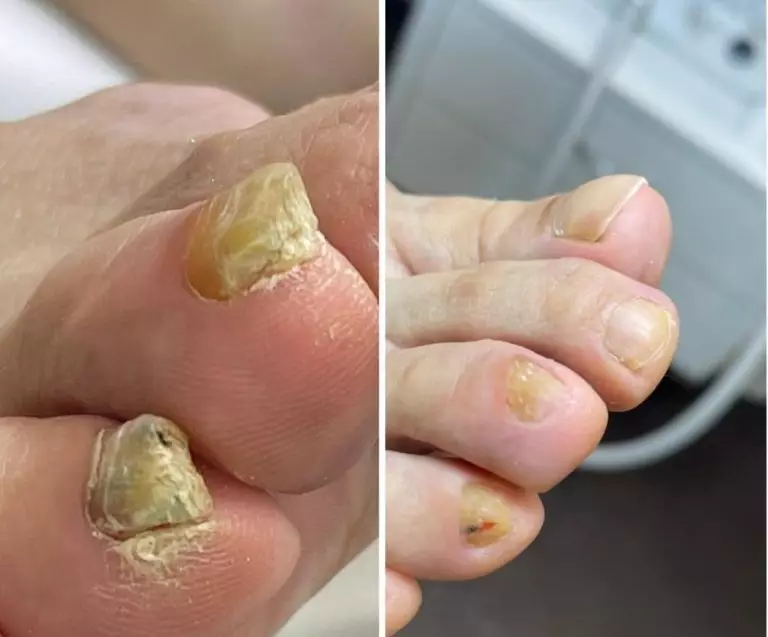 Лечение грибкового поражения ногтей